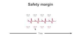 Pacemaker Issues Explained (Part 1): Understanding Failure to Capture