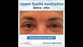 Upper Eyelied (Blepharoplasty) Surgery - Before & After | mezMD Health Tourism Agency