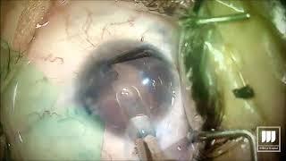 Iris prosthesis implant surgery