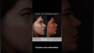 Before and after rhinoplasty - Dr Guncel Ozturk #beforeandafter #drgo #rhinoplastyturkey #burun