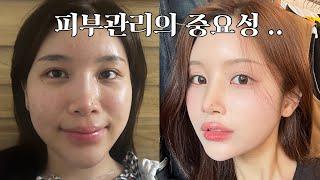 여드름 피부 관리 방법이요 ? (인공눈물, 피부관리, 홈케어로만 3년차)