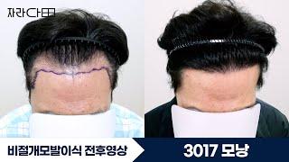 3017모낭 대량이식 M자 전두부 #자라다의원