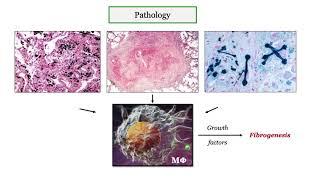 12DaysinMarch, Pneumoconioses for the USMLE Step One Exam