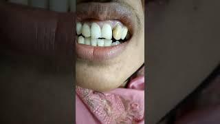#Discolour teeth treatment @dr tajul islam@ma oral and dental care #viralvideo #dentalclinic