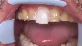 Houston Cosmetic Dentist...Step by step procedure for Porcelain Veneers...Conservative preps!