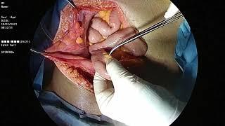 Technique of completely diverted tube ileostomy