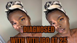 DIAGNOSED WITH VITILIGO AT 25 | DOSEOFJASS