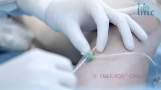 biolitec® medical laser: ELVeS Radial 2ring™ - Laser Therapy today