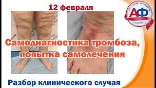 Самодиагностика тромбоза, попытка самолечения