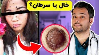 10 علامت سرطان پوست که لازمه بدونید| melanoma