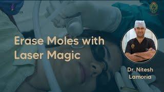 Best Laser Mole Removal Treatment || Dr Nitesh Lamoria || Purple Heron Hospital Jaipur