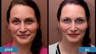 Anti-aging proměny Perfect Clinic Dermatology - spot