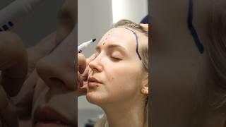 Cosmedica Clinic Female Hair Transplant in Turkey #shorts #hairtransplant #video