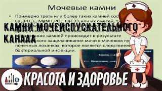 Камни мочеиспускательного канала