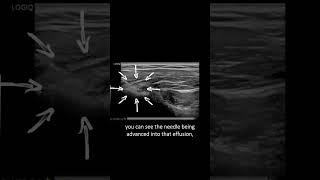 #ultrasound Guided Interventions: Cases (Long Head of Biceps Injection)