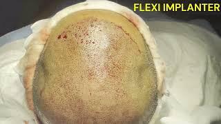 Flexi Implanter Hair Transplant | Hair Transplant in Mumbai | Harleys Clinic