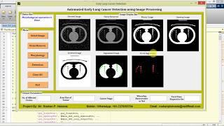 Matlab Project for Early Lung Cancer Detection Using Image Processing Full Source Code