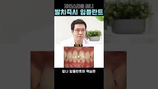 저 앞니 임플란트한거 아무도 모르게 해주세요.. 자연스러운 앞니 임플란트를 위해 필요한것은?