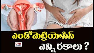 ఎండోమెట్రియోసిస్ ఎన్ని రకాలు ?| endometriosis| CVR Health News