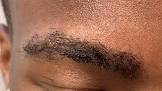 Dallas 5 Month Early African American Male Eyebrow Transplant Close-Up Result