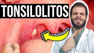 TONSILOLITOS ¿Cómo ELIMINAR las bolitas blancas de la garganta?