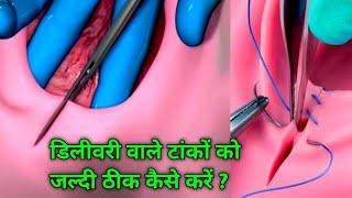 डिलीवरी  के टांकों को जल्दी ठीक करने का तरीका #Episiotomy #deliverystitches