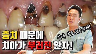 충치 때문에 치아가 부러진 환자, 당일 치료 과정 공개 (feat.신경치료&임시치아)