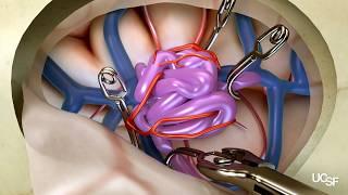 Arteriovenous Malformations (AVMs) | Surgical Treatment Options at UCSF