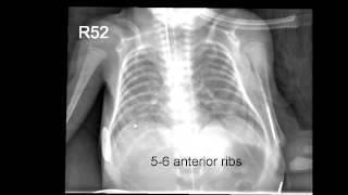 Neonatal Radiography part 1: Nomal Findings and the Basics