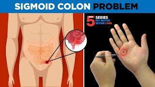 Sujok Treatment For Sigmoid Colon's Problems