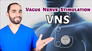 Vagus Nerve Stimulation (VNS) for Epilepsy