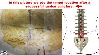 POCUS: Ultrasound Guided Lumbar Puncture