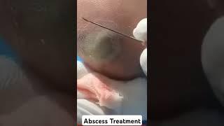 Abscess treatment #shorts #short #ytshorts #skincare