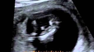 sex fetal feminin (fetita) la morfologia fetala din trimestrul 1