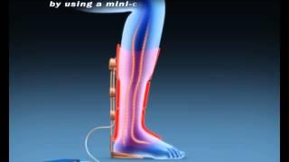 C boot Medical animations Mvr