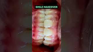 Smile makeover   #smile #shorts #trending #youtube @drneetuagarwal