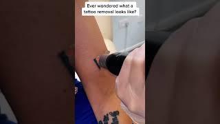 How painful do you think this is? #tattooremoval #shorts #tattooremove #tattoolover #tattooremover