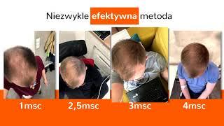 Medestetic Zielona Góra - Przeszczep włosów - metoda FUE