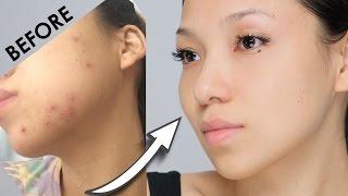 Remove Acne Marks | 3 Home Remedies (100% Works) With Results