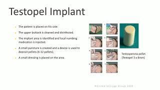 Testosterone Replacement   Testopel Implant