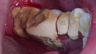 TARTAR - SCALING | Dentist | Dokter Gigi Tri Putra