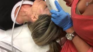 Ultherapy Brow Treatment | Woodlands Medical Aesthetics Institute