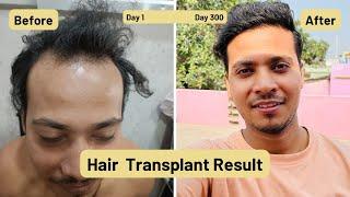 Day 1 to Day 300 Hair Transplant result / Hair Transplant in Jharkhand / 22k views