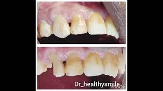 COMPOSITE RESTORATION #dentalstudies #aestheticdentistry #compositerestoration #dentistry