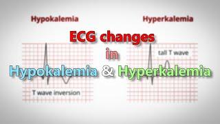 Hypokalemia and Hyperkalemia ECG changes