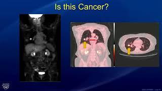 Molecular Imaging for the Detection of Cancer