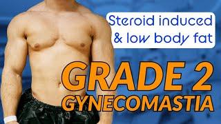 Bodybuilder Gyno Fix: Steroid-Induced Grade 2 Surgery with Dr Dadvand