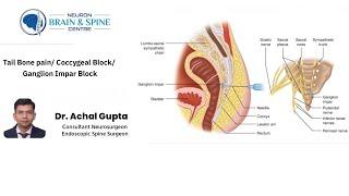 Tail bone pain/ Coccygeal block/ Ganglion Impar block - Dr. Achal Gupta - Neuro & Spine Surgeon