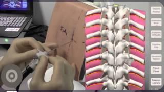 Needle Angulation for Thoracic Paravertebral Block (TPVB)