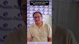 Hair transplant Results Before and after #skinandhairclinic #baldtobold #akarshan  #hairtransplant